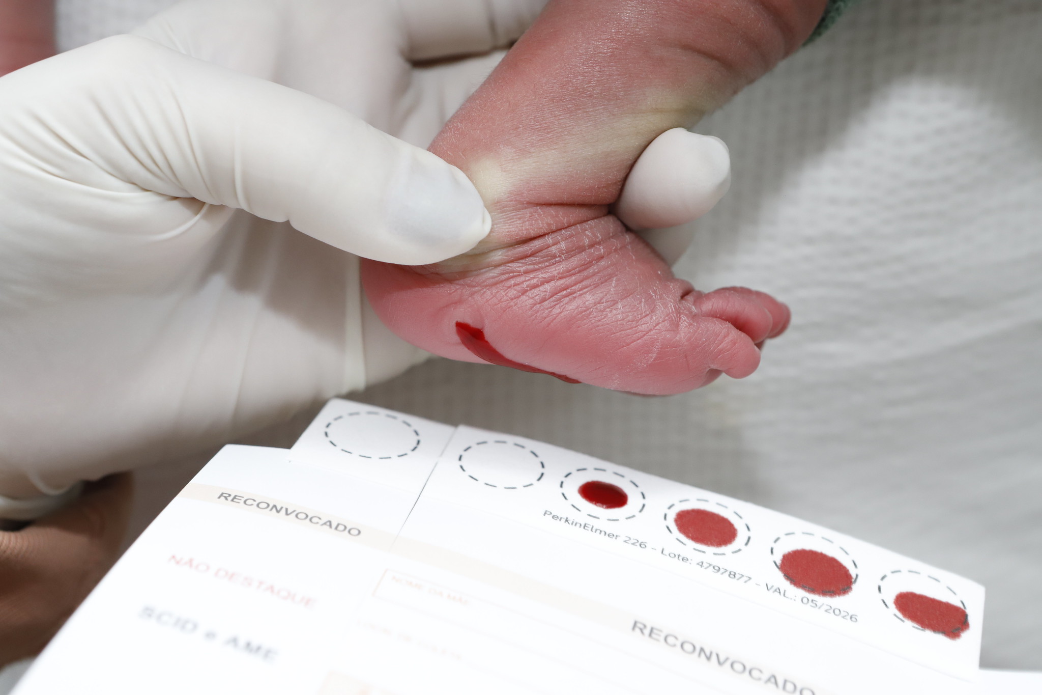 Teste do Pezinho: resultado garante saúde para milhares de crianças no DF