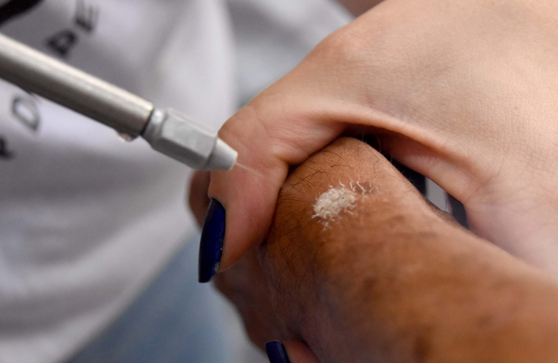 Tratamento com nitrogênio líquido para lesões na pele | | Foto: Tony Winston/Secretaria de Saúde